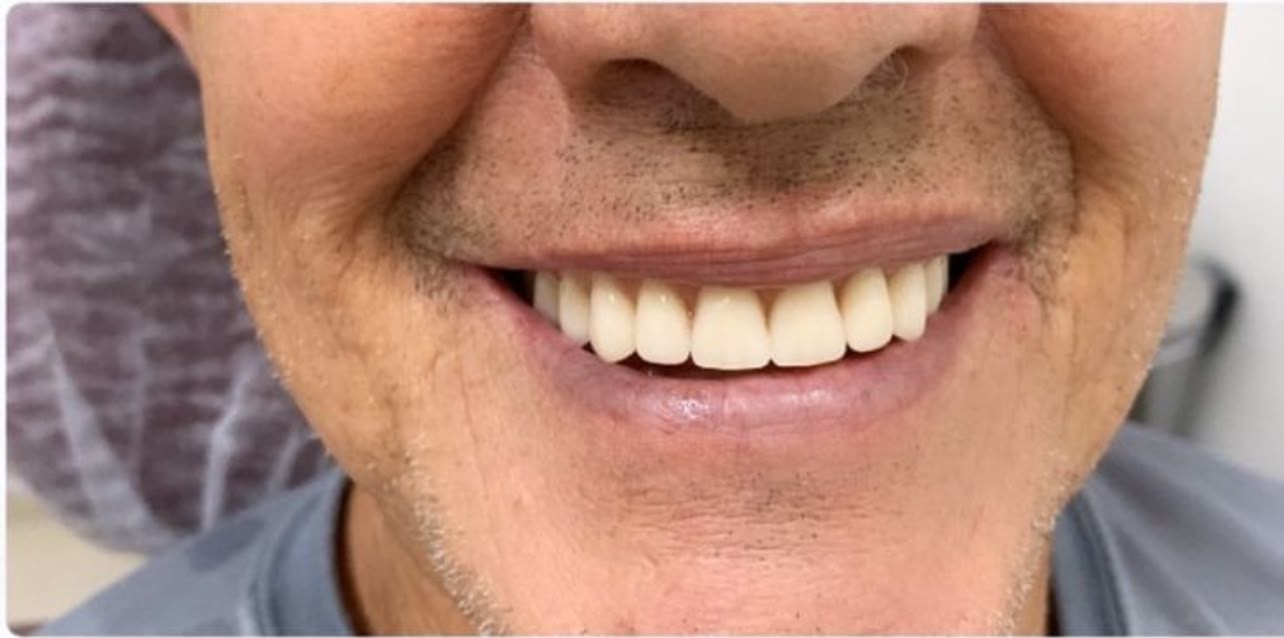 Depois do tratamento de Prótese dentária