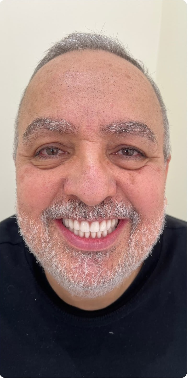 Depois do tratamento de Protocolo carga imediata