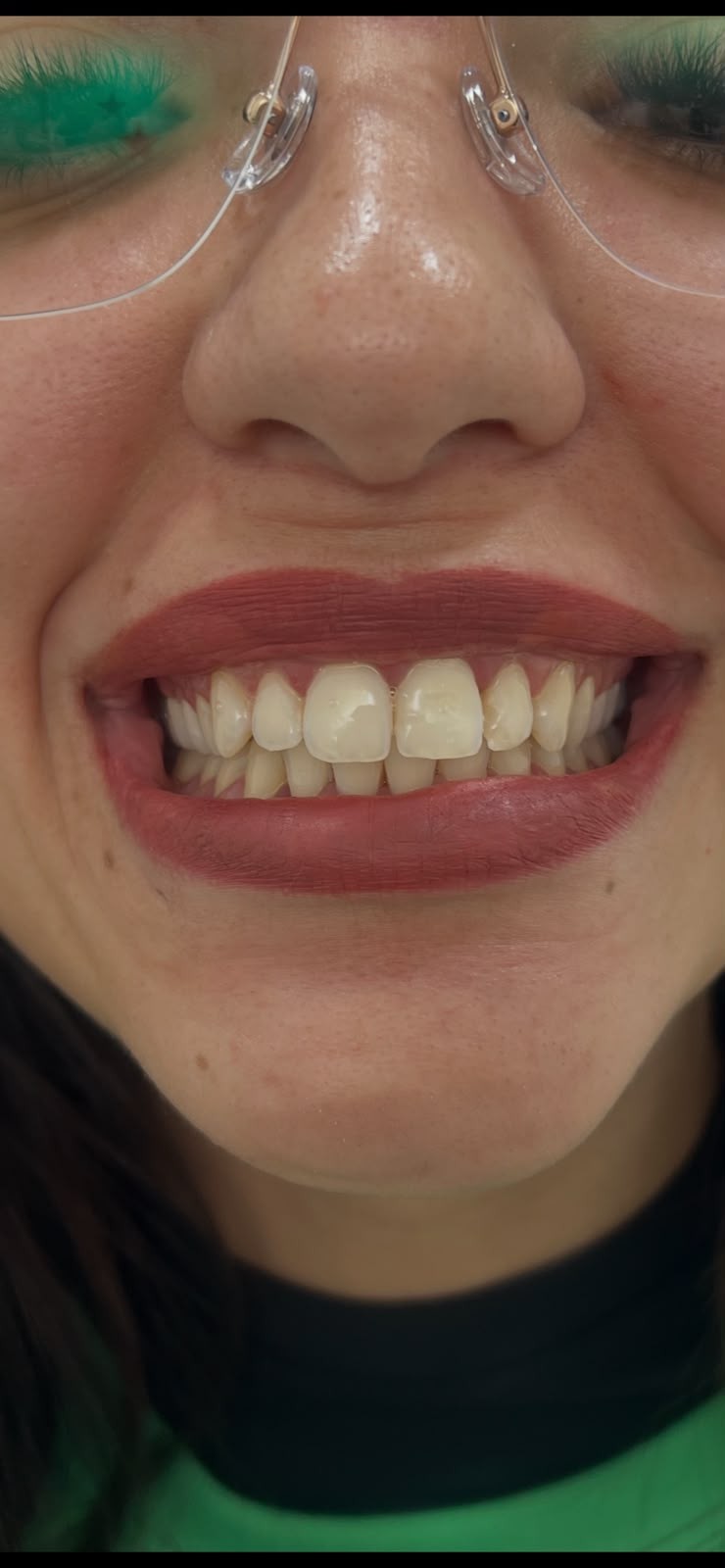 Antes do tratamento de Clareamento dental