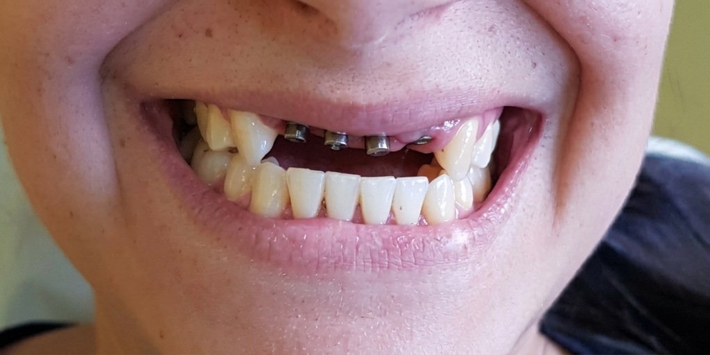 Antes do tratamento de Implantes dentários